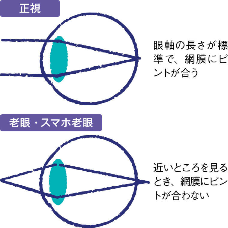 正視と老眼・スマホ老眼のピントの違い