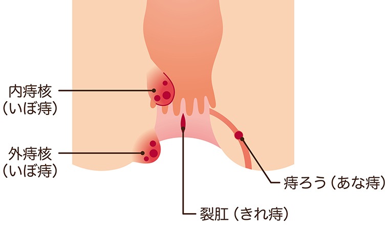 いぼ痔、あな痔、きれ痔