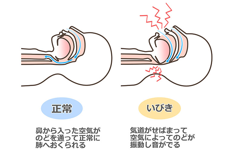 いびきが起きるメカニズム