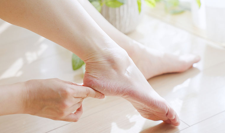踵の乾燥や角質が気になる女性