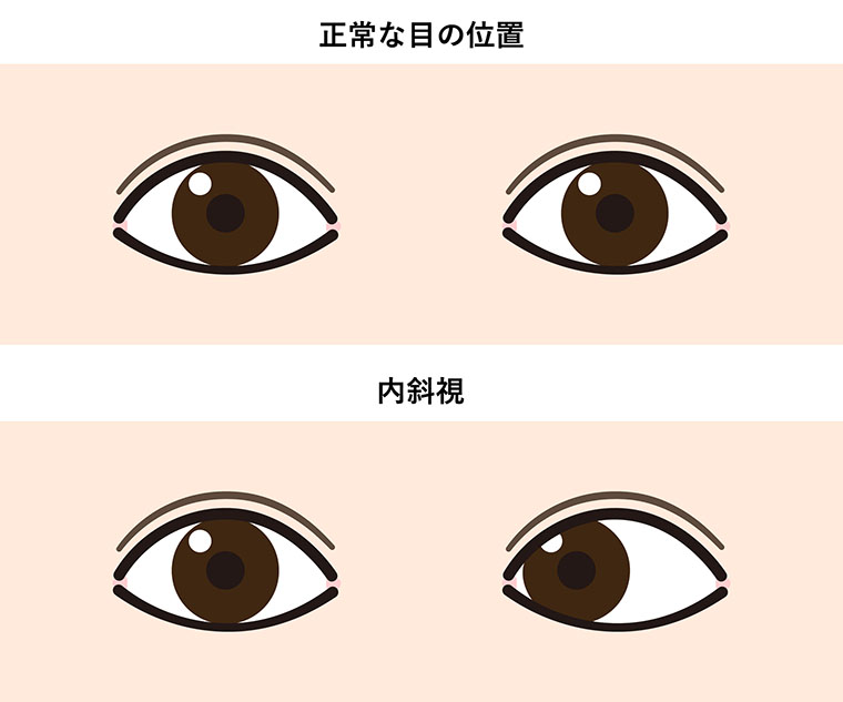 内斜視