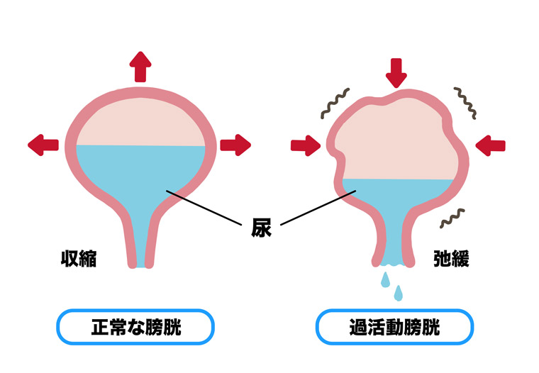 正常な膀胱と過活動膀胱の比較イラスト
