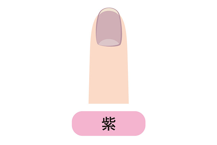 紫色に変色した爪
