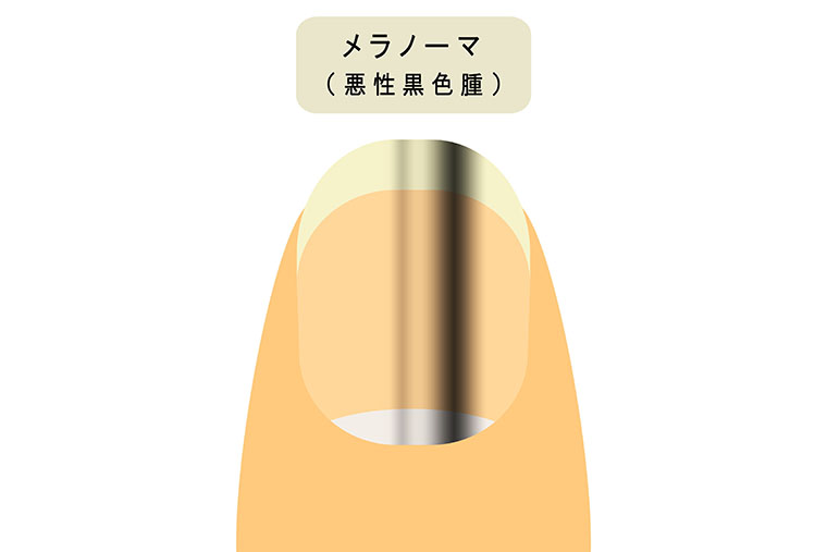 メラノーマ
