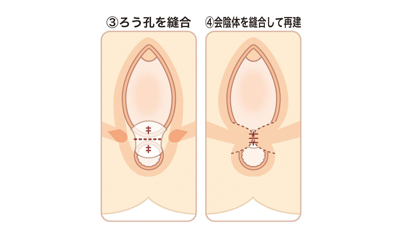 直腸膣ろう手術