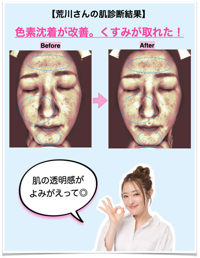 荒川さんの肌診断結果